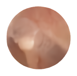 After Removal